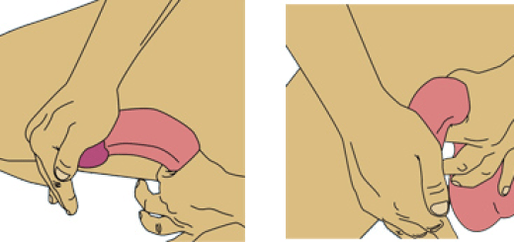 陰茎の拡大のための屈曲